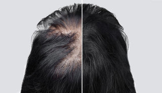How to Prevent Hair Loss from Stress